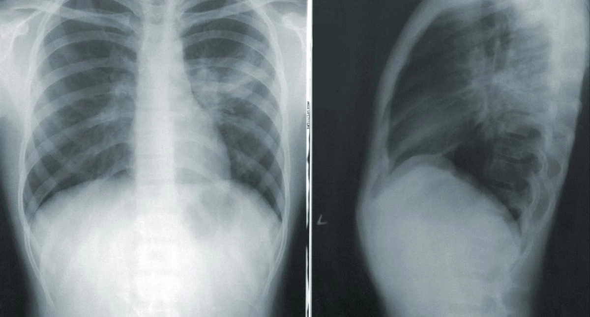 Szpital Narutowicza w Krakowie ponownie otworzył oddział chorób płuc