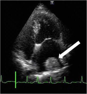 Left atrium mass